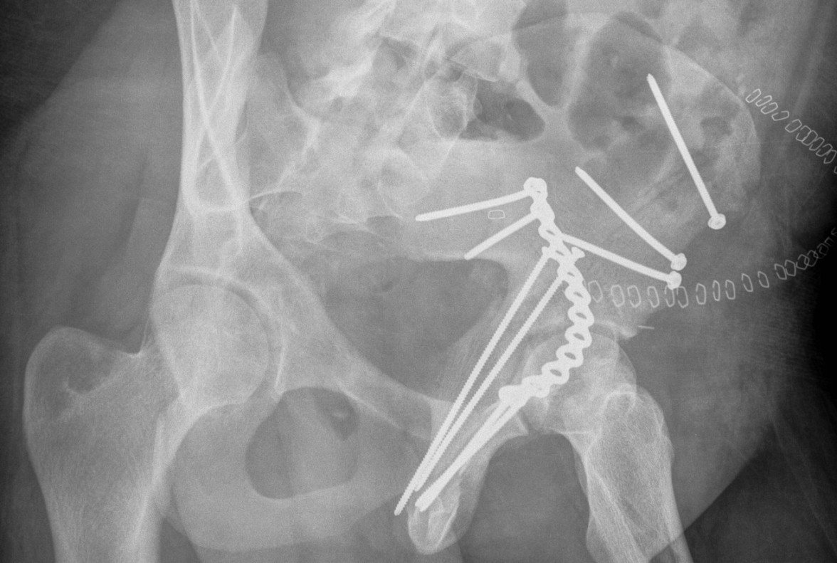 Acetabulum ORIF 2 Column Judet 1